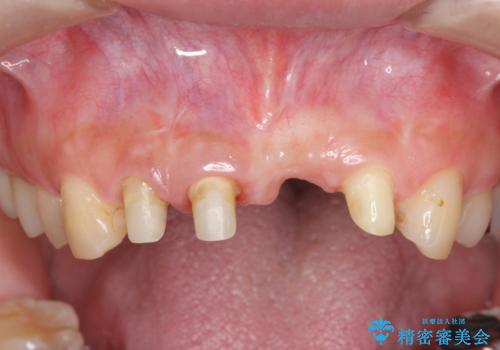 不良インプラントの除去・骨造成・歯肉移植・前歯審美セラミックブリッジ製作の治療中