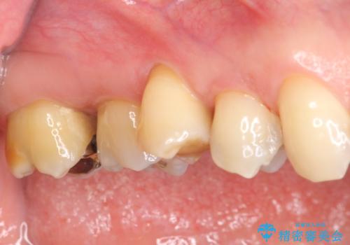 部分矯正を含む 歯周病治療 (再生治療・歯周ポケット除去・MTM・連結補綴)の症例 治療前