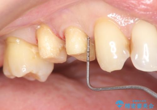 部分矯正を含む 歯周病治療 (再生治療・歯周ポケット除去・MTM・連結補綴)の治療後