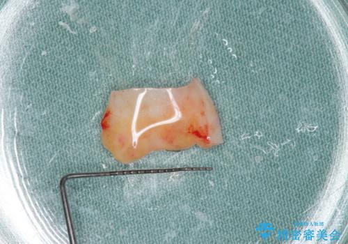 不良インプラントの除去・骨造成・歯肉移植・前歯審美セラミックブリッジ製作の治療後