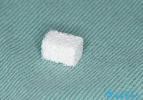 不良インプラントの除去・骨造成・歯肉移植・前歯審美セラミックブリッジ製作の治療後