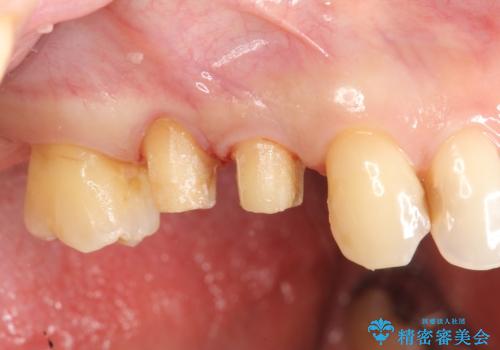 部分矯正を含む 歯周病治療 (再生治療・歯周ポケット除去・MTM・連結補綴)の治療前