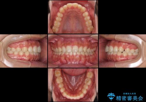 インビザラインによる、すきっ歯の改善の治療中