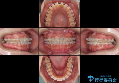 前歯の反対咬合 非抜歯のワイヤー矯正の治療中