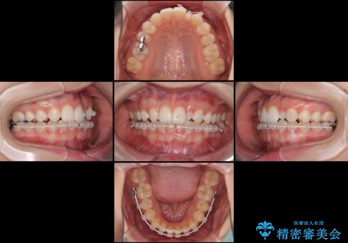海外転居前に気になる前歯を整えたい　上下前歯の部分矯正の治療中