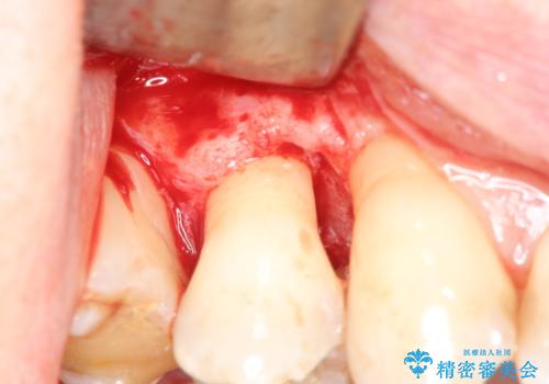 部分矯正を含む 歯周病治療 (再生治療・歯周ポケット除去・MTM・連結補綴)の治療後