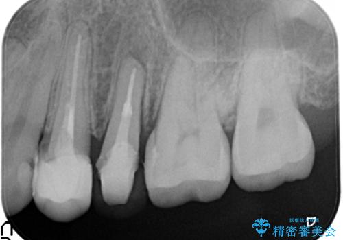 歯肉の中までの深い虫歯　部分矯正後のセラミック治療の治療中