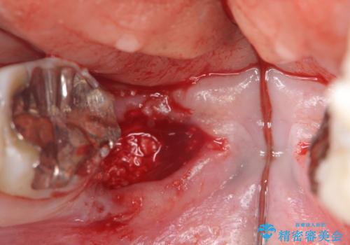 歯の破折による抜歯 インプラントによる咬合機能回復の治療前