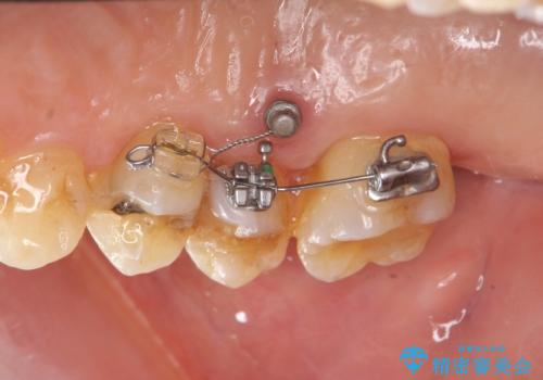 部分矯正を含む 歯周病治療 (再生治療・歯周ポケット除去・MTM・連結補綴)の治療中