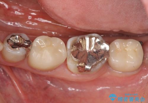 歯の破折による抜歯 インプラントによる咬合機能回復の治療後