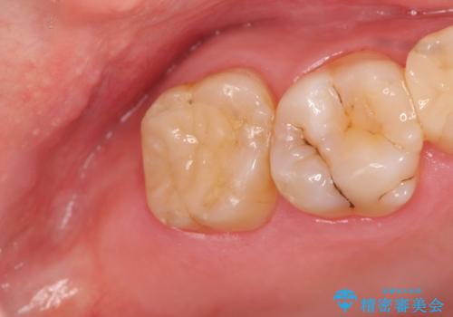 銀歯の劣化・セラミックインレー修復の治療後