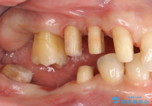 部分矯正を含む 歯周病治療 (再生治療・歯周ポケット除去・MTM・連結補綴)の治療中