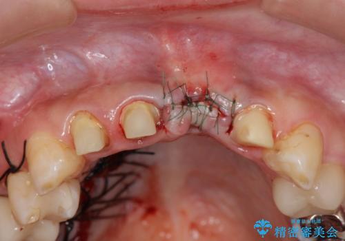 不良インプラントの除去・骨造成・歯肉移植・前歯審美セラミックブリッジ製作の治療前