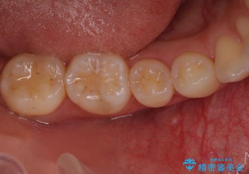 このままでは抜歯と言われた 失われた骨の再生治療 の治療前