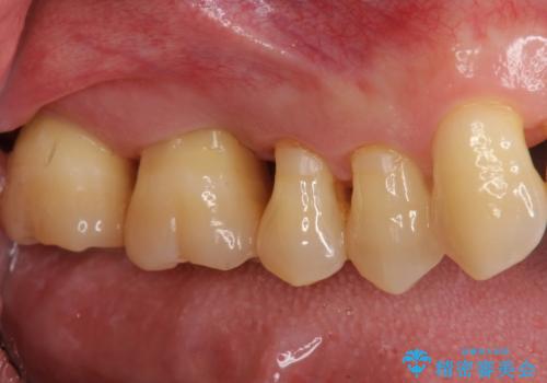 [歯周病治療]　再生療法　歯肉弁根尖側移動術の治療前