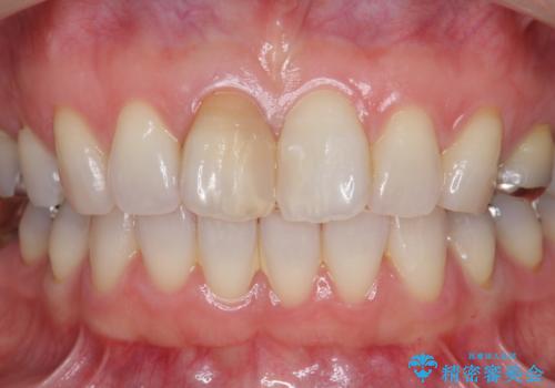 前歯の変色 セラミック審美補綴の治療前