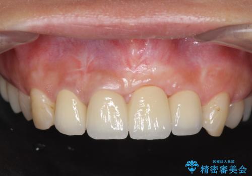 不良インプラントの除去・骨造成・歯肉移植・前歯審美セラミックブリッジ製作の症例 治療後