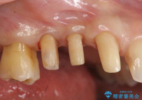 部分矯正を含む 歯周病治療 (再生治療・歯周ポケット除去・MTM・連結補綴)の治療中