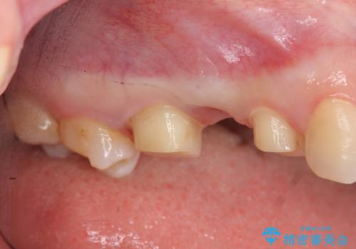 [深い虫歯] 根管治療・歯周外科治療を行い歯を保存するの治療前