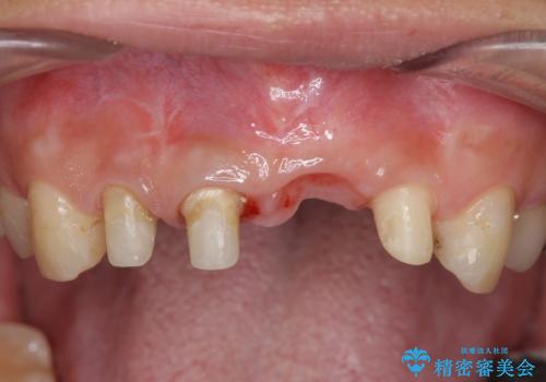 不良インプラントの除去・骨造成・歯肉移植・前歯審美セラミックブリッジ製作の治療中
