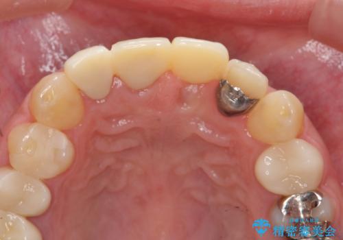 不良インプラントの除去・骨造成・歯肉移植・前歯審美セラミックブリッジ製作の治療前