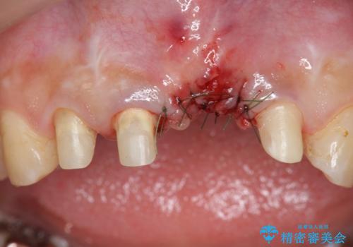 不良インプラントの除去・骨造成・歯肉移植・前歯審美セラミックブリッジ製作の治療中
