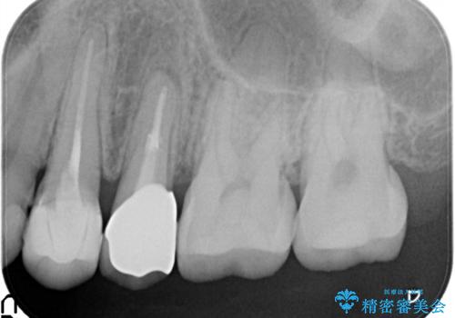 歯肉の中までの深い虫歯 部分矯正後のセラミック治療の治療後