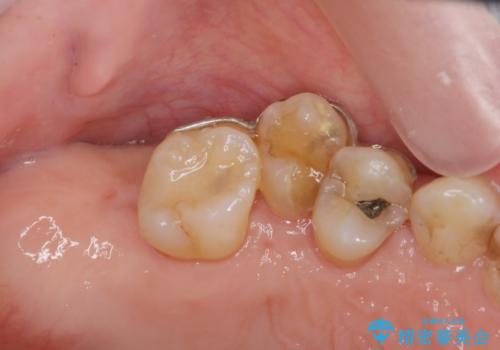 部分矯正を含む 歯周病治療 (再生治療・歯周ポケット除去・MTM・連結補綴)の治療前