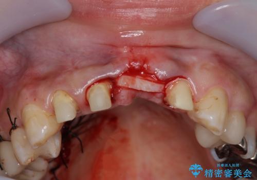 不良インプラントの除去・骨造成・歯肉移植・前歯審美セラミックブリッジ製作の治療後