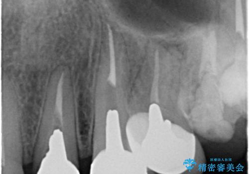 セラミックと矯正を併用してきれいな前歯への治療前
