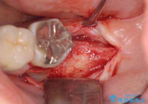 歯の破折による抜歯 インプラントによる咬合機能回復の治療前