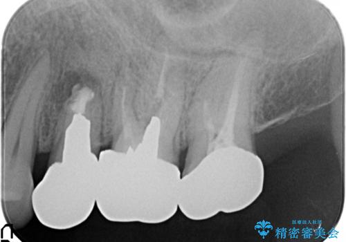 小臼歯部のインプラントの症例 治療前