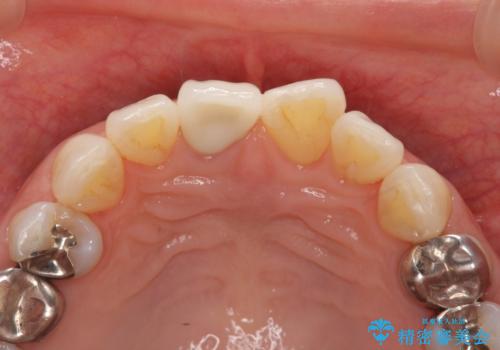 前歯の変色 セラミック審美補綴の治療後