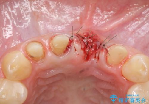 不良インプラントの除去・骨造成・歯肉移植・前歯審美セラミックブリッジ製作の治療後