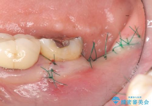 歯の破折による抜歯　インプラントによる咬合機能回復の治療前
