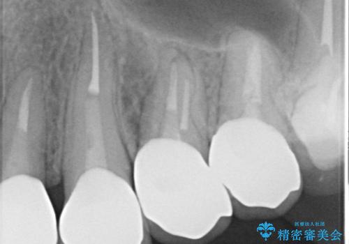 セラミックと矯正を併用してきれいな前歯への治療後