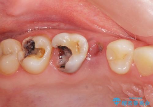 [深い虫歯] 根管治療・歯周外科治療を行い歯を保存するの症例 治療前