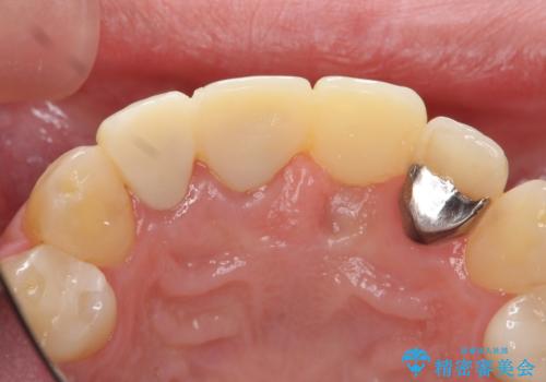 不良インプラントの除去・骨造成・歯肉移植・前歯審美セラミックブリッジ製作の治療前