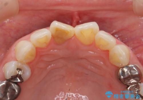 前歯の変色 セラミック審美補綴の治療前