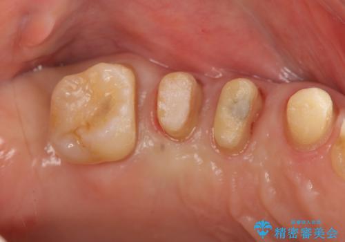 部分矯正を含む 歯周病治療 (再生治療・歯周ポケット除去・MTM・連結補綴)の治療中