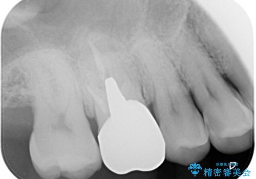 体調が悪いと腫れる 根管治療とセラミック治療の治療前