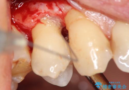 部分矯正を含む 歯周病治療 (再生治療・歯周ポケット除去・MTM・連結補綴)の治療前