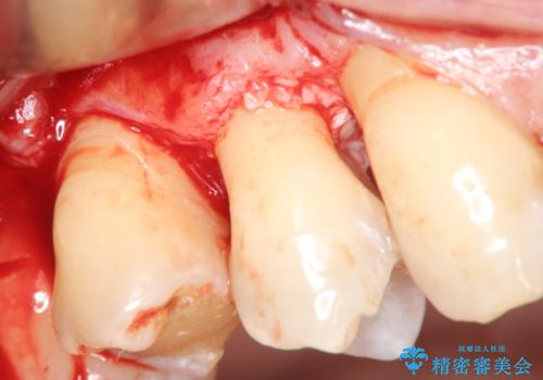 部分矯正を含む 歯周病治療 (再生治療・歯周ポケット除去・MTM・連結補綴)の治療中