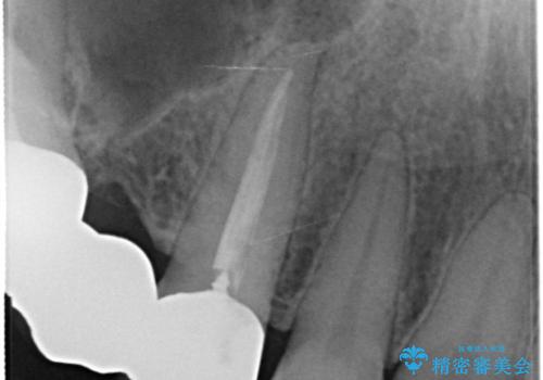セラミックと矯正を併用してきれいな前歯への治療前