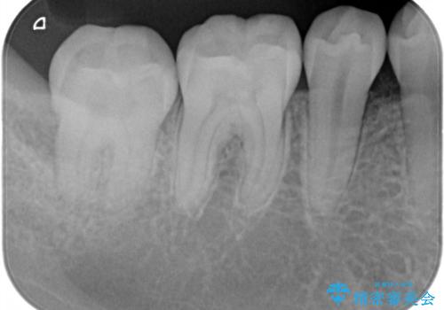 このままでは抜歯と言われた 失われた骨の再生治療 の治療後