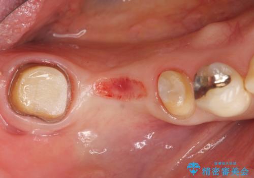 [大臼歯分岐部病変] ブリッジによる咬合機能回復の治療中