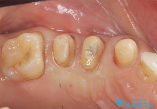 部分矯正を含む 歯周病治療 (再生治療・歯周ポケット除去・MTM・連結補綴)の治療中