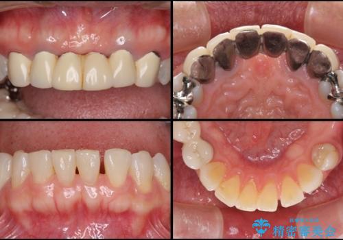 飛行機を利用しての通院 気になる所を全て治療する総合歯科治療の治療前