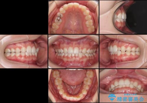 海外転居前に気になる前歯を整えたい 上下前歯の部分矯正の治療前