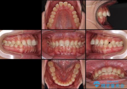 インビザラインによる、すきっ歯の改善の治療前